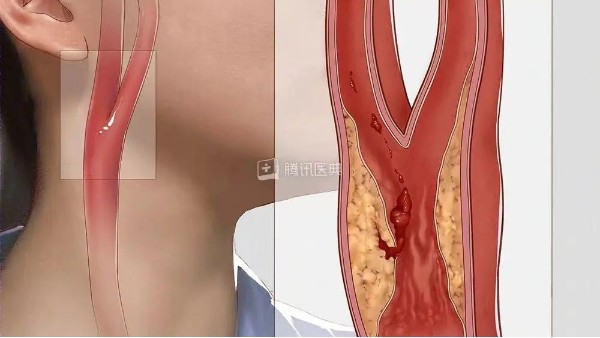 真實(shí)案例丨3個(gè)月左頸動(dòng)脈狹窄降低約27%，是怎么實(shí)現(xiàn)的？