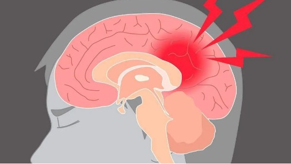 水蛭治療缺血性腦血管病療效肯定、安全簡便，已被各家公認(rèn)