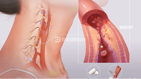 真實案例 | 從有到無，一個月多雙頸動脈斑塊“消失術(shù)”