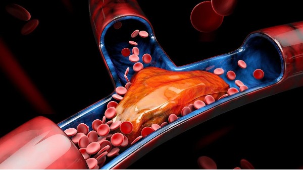 血栓最容易堵在身體3個(gè)地方！有這4個(gè)信號(hào)一定要留意→