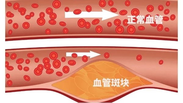 微血栓堵塞可能會(huì)致命