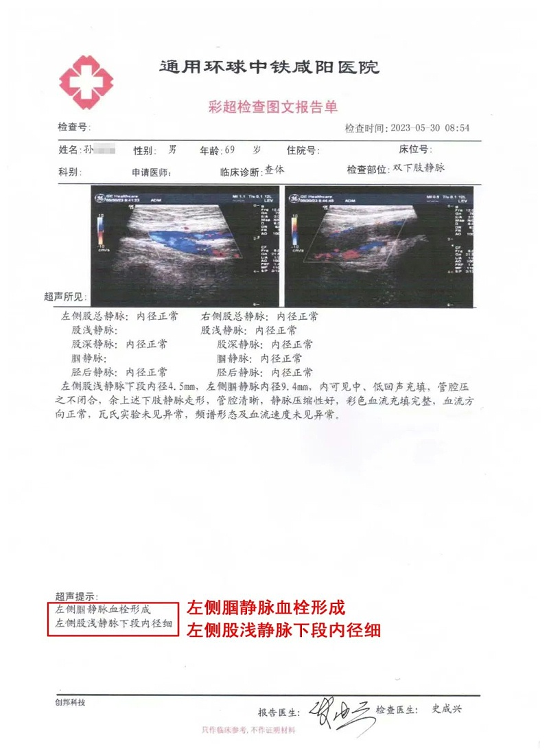 水蛭素、靜脈斑塊、血栓