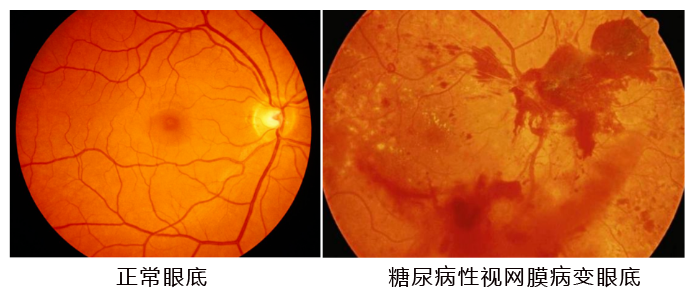 水蛭素、糖尿病、視網(wǎng)膜病變