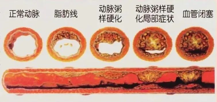 水蛭素、動(dòng)脈粥樣硬化、高血壓