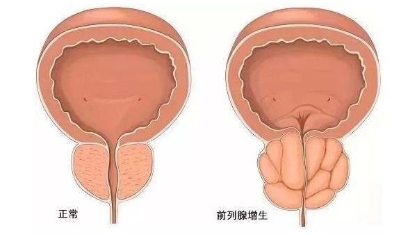 水蛭在改善前列腺增生臨床癥狀、提高生活質(zhì)量方面發(fā)揮重要作用