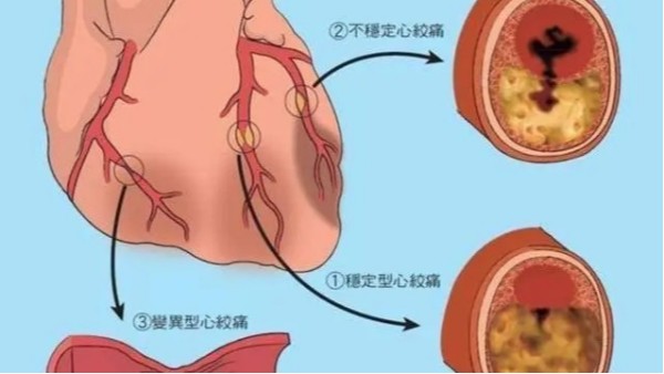 尿酸高不僅導(dǎo)致痛風(fēng)，還可能威脅你的心臟和大腦！